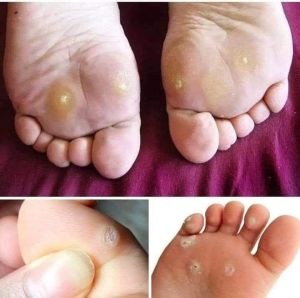 أعظم دواء علاج مسمار القدم الفعال بدون ادوية