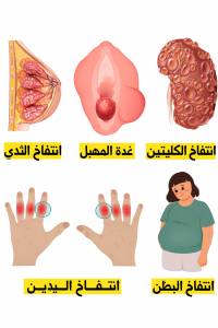 ✅️ انتفــاخ الكليتيــن : بسبب انسداد الأنابيب التــي تصرف البول من الكلى ✅️ غدة المهبل (كيسة بارثولين)